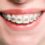 Tipos de ortodoncia y precios aproximados