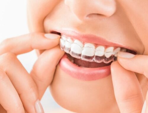 Tipos de ortodoncia invisible, la mejor alternativa a los brackets